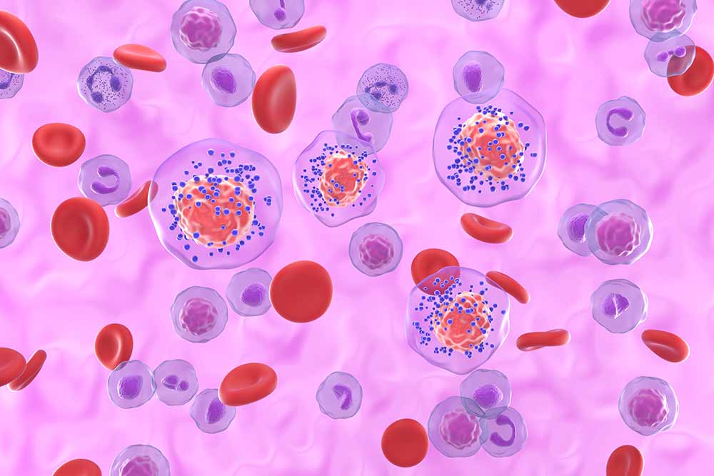 A graphic depiction of triple-negative breast cancer.